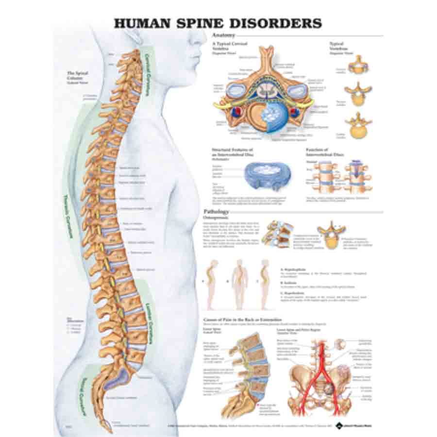 CHART THE HUMAN SPINE- DISORDERS