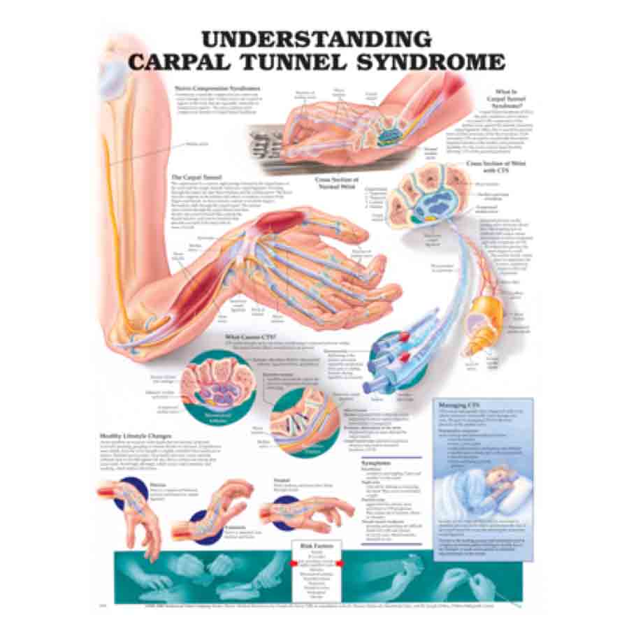 CHART UNDERSTANDING CARPAL TUNNEL SYNDROME